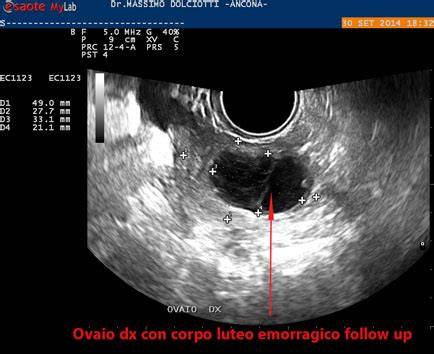 Ecografia corpo luteo emorragico ring of fire