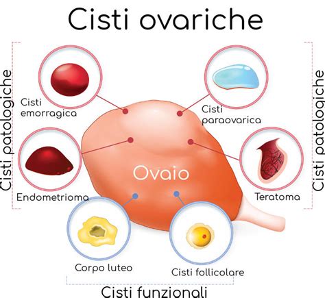 Risonanza magnetica cisti ovarica emorragica