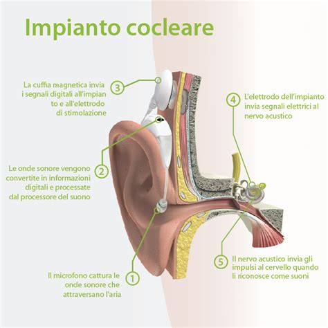 Impianto cocleare anatomia orecchio