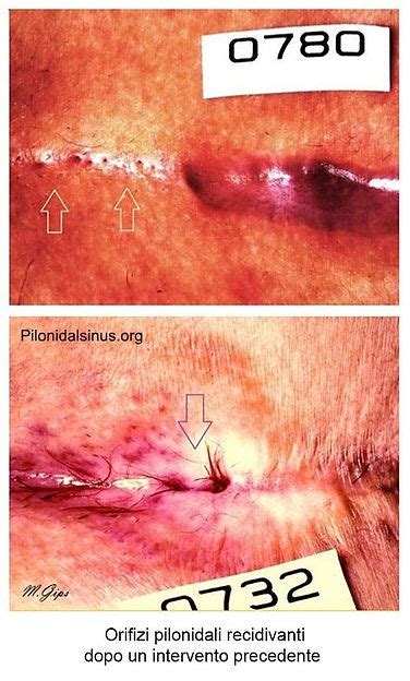 procedura EPSiT per malattia pilonidale
