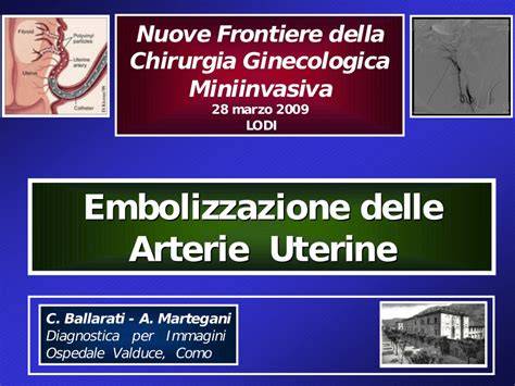Embolizzazione delle arterie emorroidarie